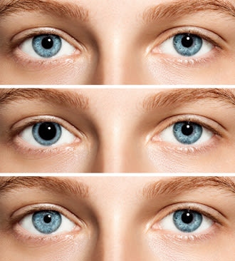 Anisocoria is a condition where one pupil is larger than the other.