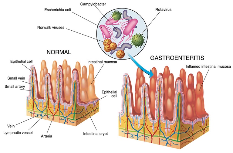 Gastroenteritis is a condition that can be caused by a number of things, including a virus, bacteria, or parasites.