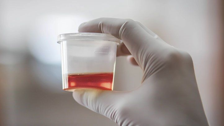 Red or pink urine is usually a sign of blood in the urine.